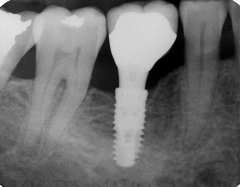 implants dentaire